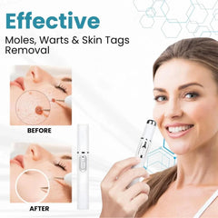 Non-Invasive Mole and Wart Removal Pen