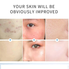 AICHUN BEAUTY Salicylic Acid Purifying Shrink Pores Exfoliation Anti-Acne Face Serum - 30ml
