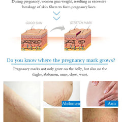 Guanjing Remove Stretch Marks Cream - 80g
