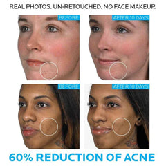 La Roche Posay Effaclar Duo Acne Spot Treatment 40ml