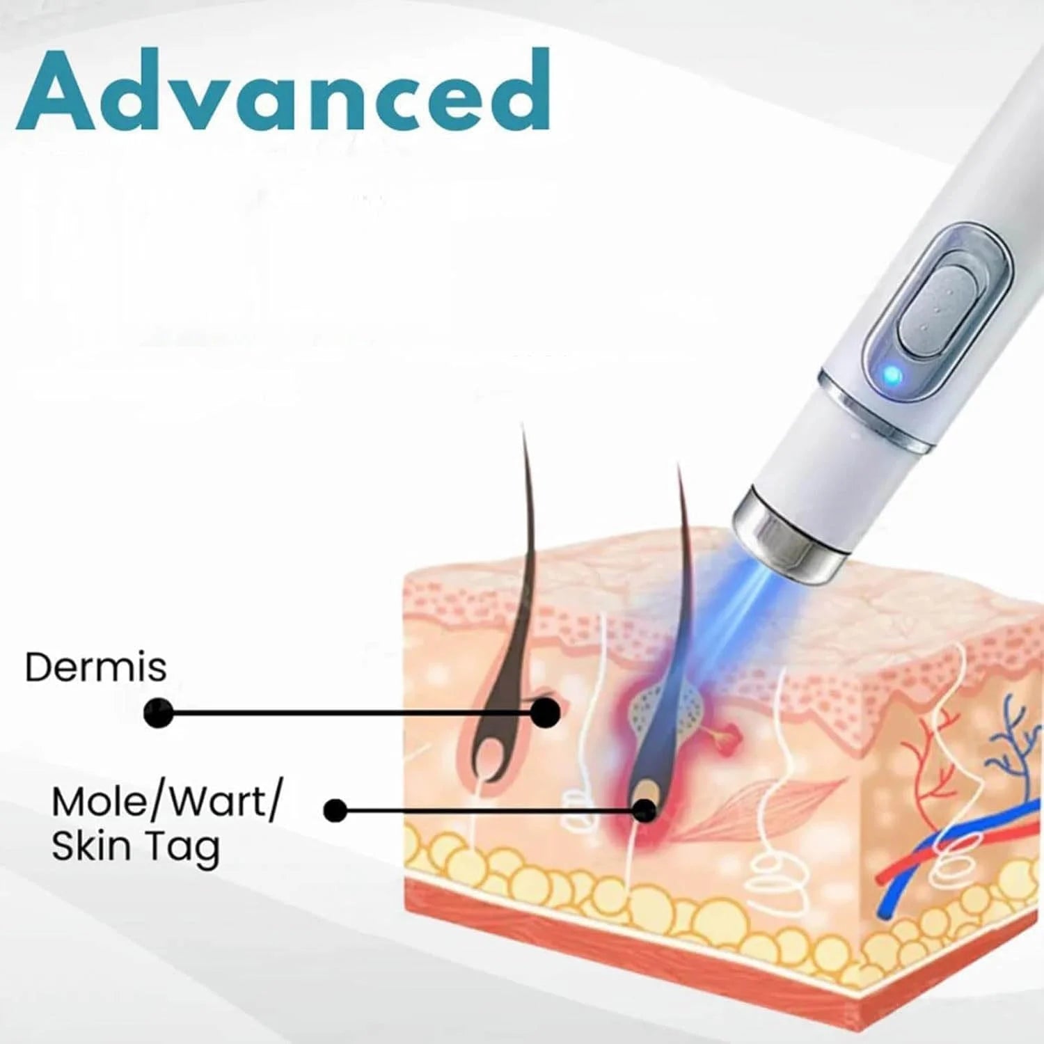 Non-Invasive Mole and Wart Removal Pen
