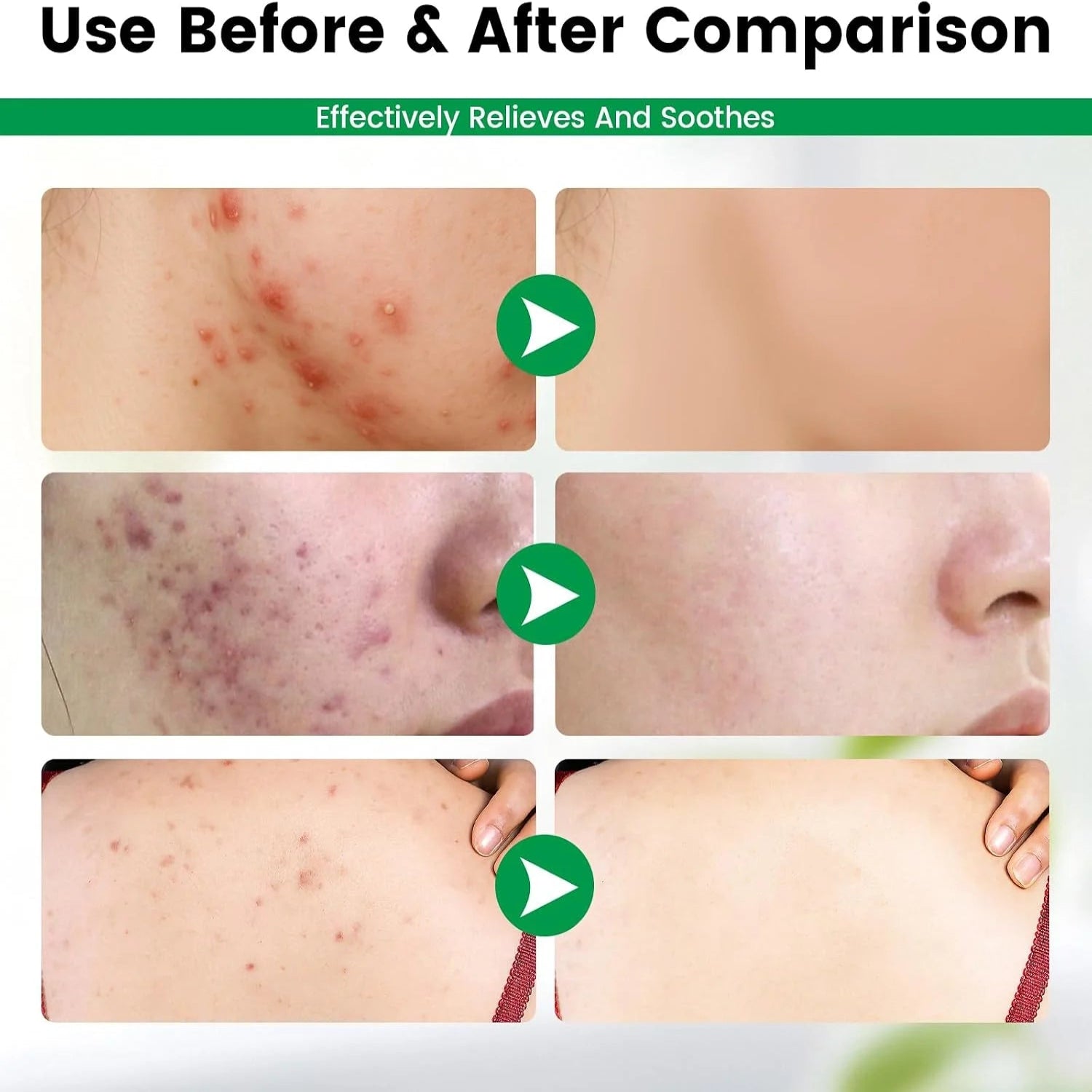 SADOER Tea tree Anti-Acne Repair Pen - 2ml