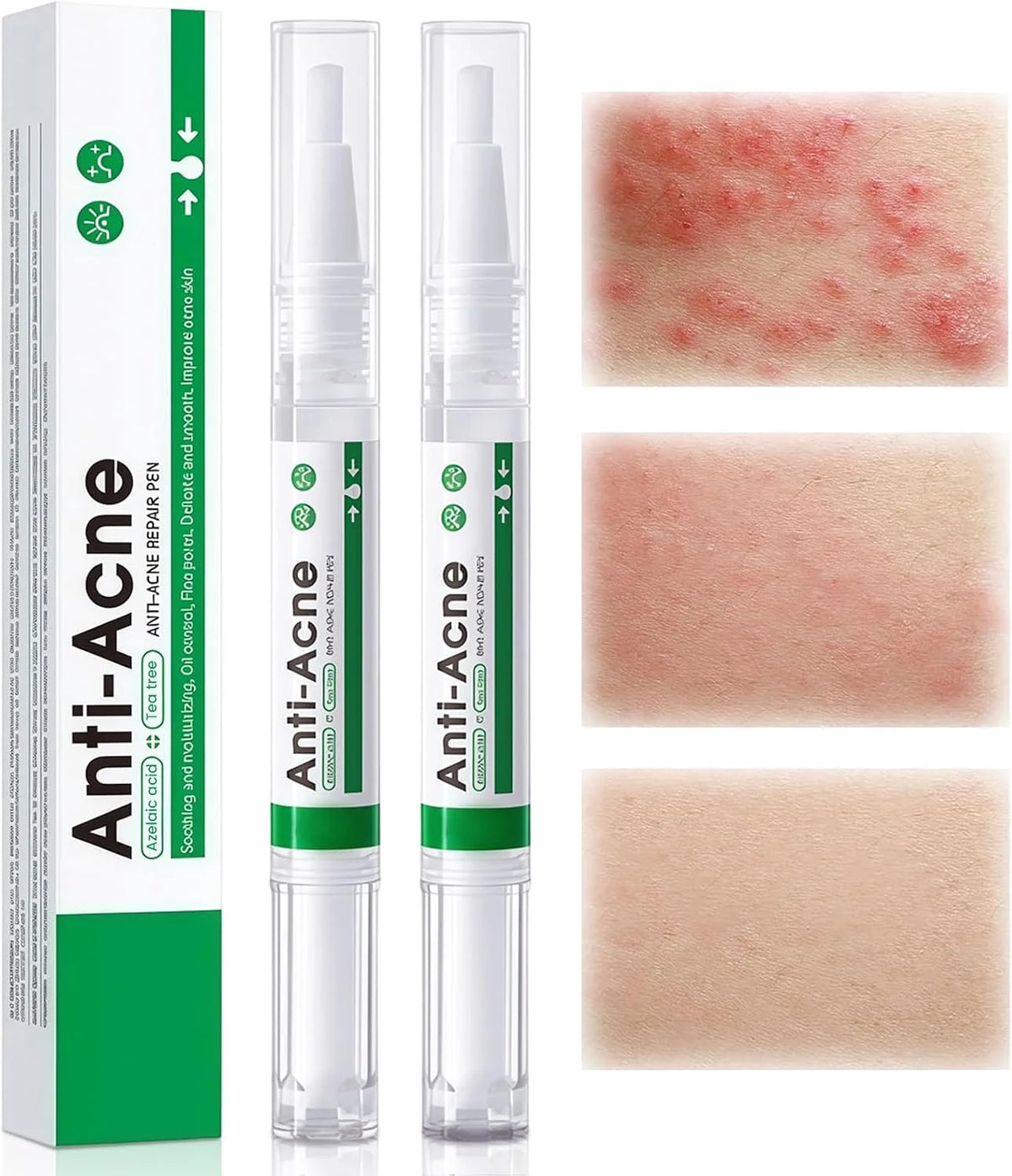 SADOER Tea tree Anti-Acne Repair Pen - 2ml