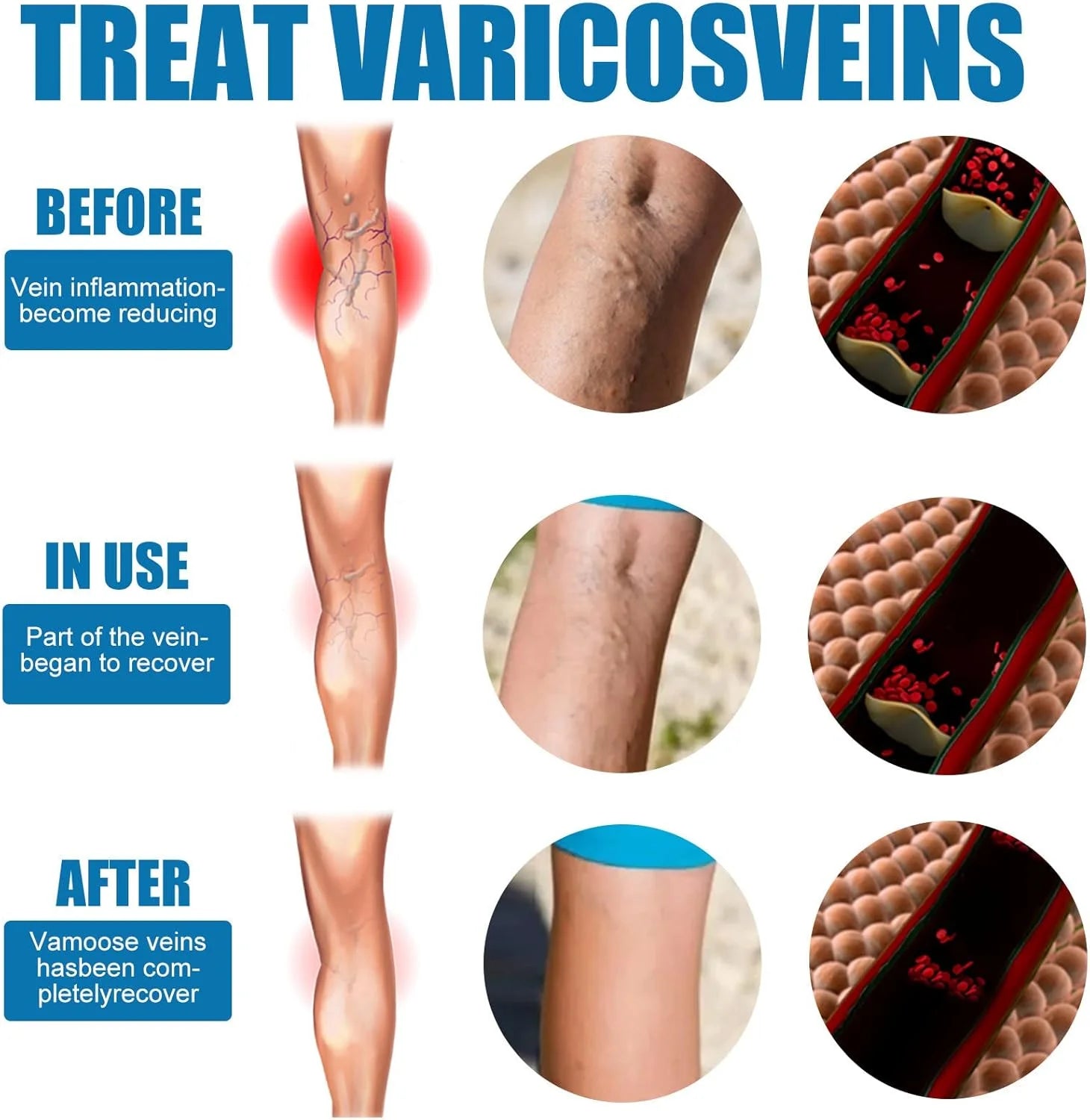 South Moon Vein Healing Varicose Veins Treatment Spray - 30ml