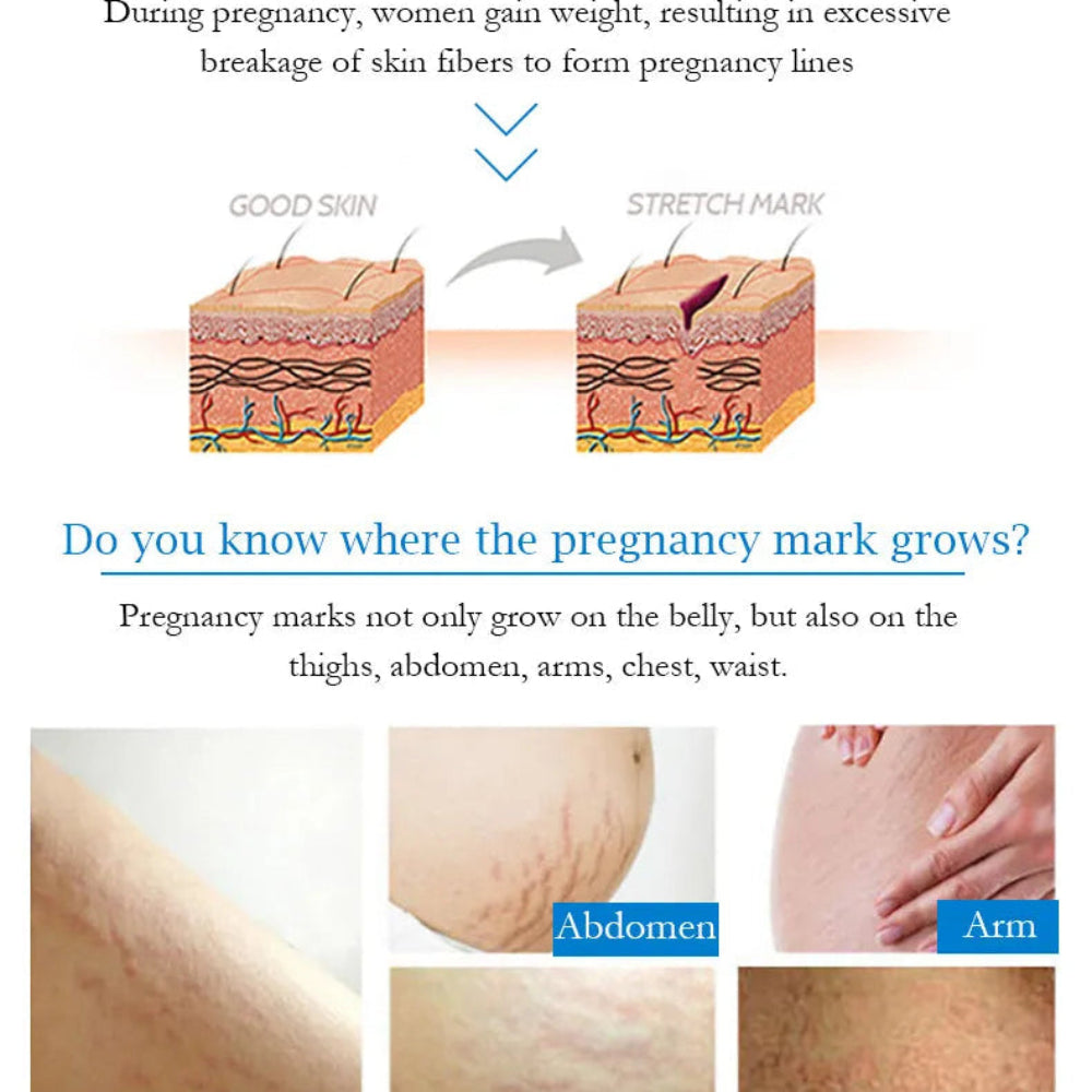 Guanjing Remove Stretch Marks Cream - 80g