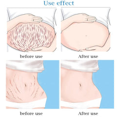 Guanjing Remove Stretch Marks Cream - 80g