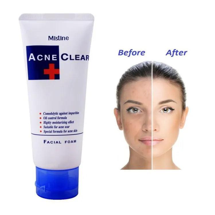 Mistine Acne Clear Facial Foam - 85ml