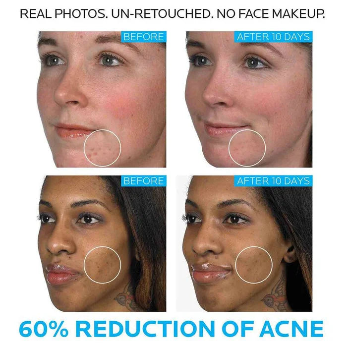 La Roche Posay Effaclar Duo Acne Spot Treatment 40ml