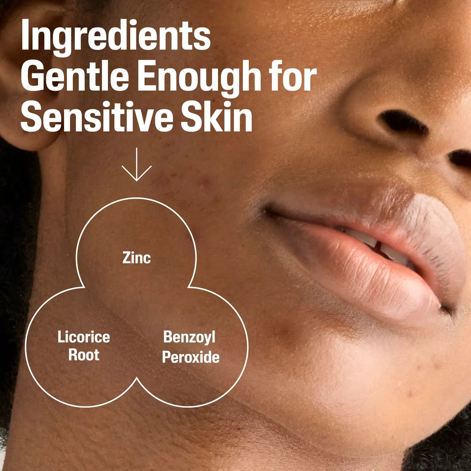 Cetaphil Gentle Clear Acne Cleanser - 124ml