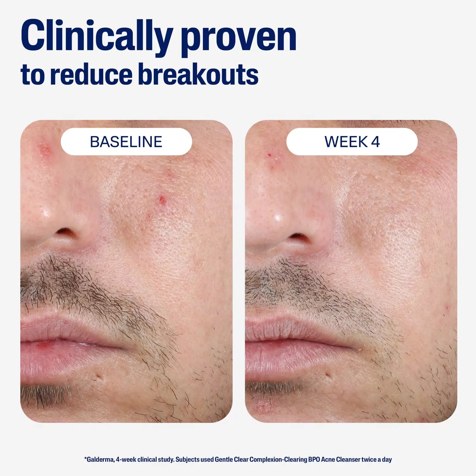 Cetaphil Gentle Clear Acne Cleanser - 124ml