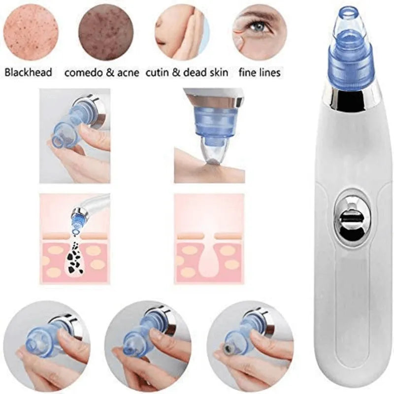 DermaSuction Cell Operated Blackhead Remover with 4 Suction Heads